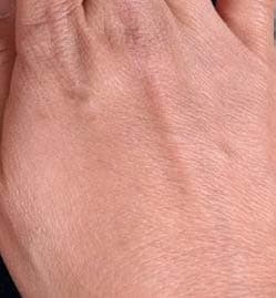 Dorsal hand control (no MCC) after 5 days